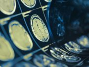 CSVD Severity Up for Minority Intracerebral Hemorrhage Survivors