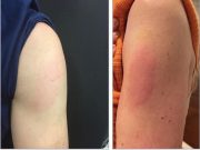 Delayed Hypersensitivity Reaction to Moderna COVID-19 Vaccine ID’d Two examples of Moderna vaccine reactions. Photo: JAMA Network