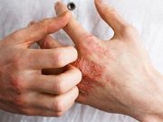 Internet-Delivered CBT Reduces Atopic Dermatitis Symptoms