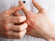Upadacitinib Treats Moderate-to-Severe Atopic Dermatitis