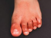 COVID-19 Weakly Correlated With Chilblains Incidence