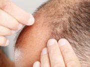 Androgenetic Alopecia May Reduce Health-Related Quality of Life