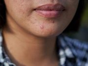 Acne Negatively Impacts Emotional Health of Adult Women