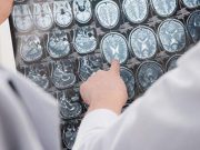 CT Findings Tied to Prognosis in Mild Traumatic Brain Injury