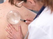 Fewer Cancers Might Be Missed With Full-Body Skin Examinations