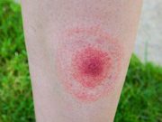 Lyme Disease Tied to Higher Risk for Psychiatric Conditions, Suicide