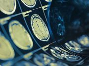 History of Concussion Impacts Cingulate Cerebral Blood Flow