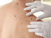 Certain Dermoscopic Structures Linked to Melanoma Detection