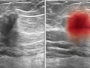 AI Could Improve Accuracy of Breast Ultrasound Diagnosis