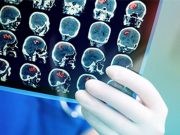 2008 to 2017 Saw Drop in Malignant Brain Tumor Incidence