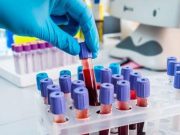 AHA: Better Management of High Cholesterol Needed in Young Adults