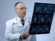 CTA May ID Pattern for Slow-Progressing Ischemic Stroke