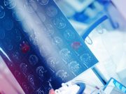 Responsive Neurostimulation Tolerated in Pediatric Epilepsy