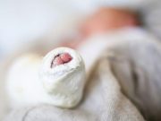 Every Infant With Clubfoot Should Have Access to Ponseti Method