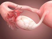 Oral Contraceptive Use Tied to Marker of Ovarian Function