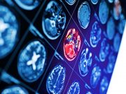 Risk for Ischemic Stroke Up With Antidopaminergic Antiemetic Use