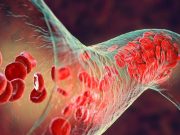 COVID-19 Linked to Increased Risk for DVT, PE, Bleeding