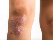 Lifestyle Factors Are Predictive of Incident Psoriasis