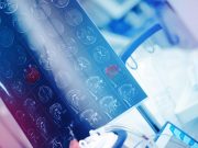 American Academy of Neurology, April 2-7 4/21 -- Portable MRIs Can Spot Brain Damage in Stroke Victims in Underserved Areas