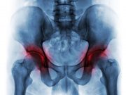 TXA Seems Safe for Surgery in High-Risk Patients With IT Hip Fracture Intra-Articular Injection of Triamcinolone Beneficial in Hip Osteoarthritis