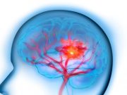 Guideline Updated for Management of Spontaneous ICH