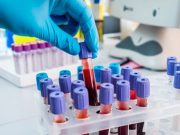 Treatment for Hep C Up Among People Who Inject Drugs