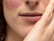 Twelve-Week Treatment Regimen Reduces Facial Redness