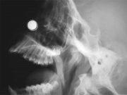 Feds Tighten Safety Standards on Tiny High-Powered Magnets That Have Injured Children