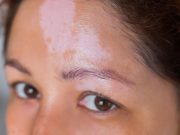Ruxolitinib Cream Results in Greater Repigmentation in Vitiligo