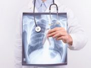 RSNA: 20-Year Survival Shows Lung Cancer Screening Effective