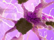 Second Death in Trial of Experimental Alzheimer Drug Raising Concerns