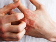 Rocatinlimab Effective for Moderate-to-Severe Atopic Dermatitis