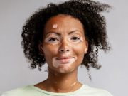 AAD: Long-Term Improvement Seen With Ruxolitinib in Vitiligo