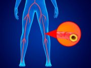 Transcatheter Arterialization Safe for Limb-Threatening Ischemia