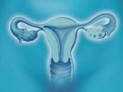 Adding Pembrolizumab to Chemo Improves Survival in Endometrial Cancer