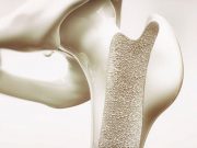 Femoral Neck BMD Lower in Men With Combat-Related Traumatic Injury