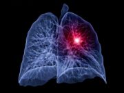 AACR: Neoadjuvant, Adjuvant Durvalumab Beneficial for NSCLC