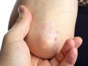 Early Intervention for Psoriasis With Guselkumab Tied to Complete Response