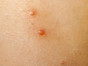 FDA Warns Against Using Bogus Treatments for Molluscum