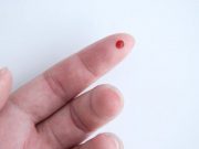 Finger Prick, Venous Blood Can ID Key Alzheimer Disease Biomarkers