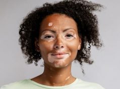 Incidence Rate of Diagnosed Vitiligo 22.6 per 100,000 Person-Years
