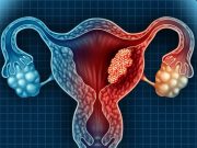 Selinexor Increases PFS for Endometrial Cancer With TP53 Mutations