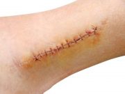 Mobile Device May ID Wound Infections Earlier