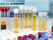 Urinary Biomarkers Can Differentiate IC/BPS From Other LUTDs