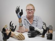 A Bionic Hand Melds With Woman’s Own Bone, Nervous System unnamed (1)