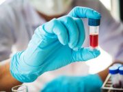 Small-Volume Blood Collection Tubes Could Cut RBC Transfusions