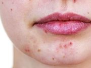 Social Stigma Associated With Adult Facial Acne
