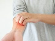 Recommendations Developed for Atopic Dermatitis Therapies