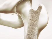 Perfluorooctanesulfonic Acid Exposure Linked to Lower Bone Density