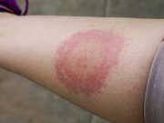 Blacks More Likely to Have Disseminated Manifestations of Lyme Disease